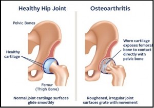 OSTEOARTHRITIS