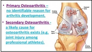 Osteoarthritis-Types