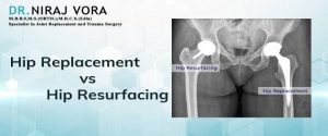 total hip replacement vs hip resurfacing